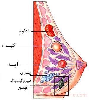ابزار هوش مصنوعی در شناسایی زنان با خطر بالای ابتلا به سرطان پستان